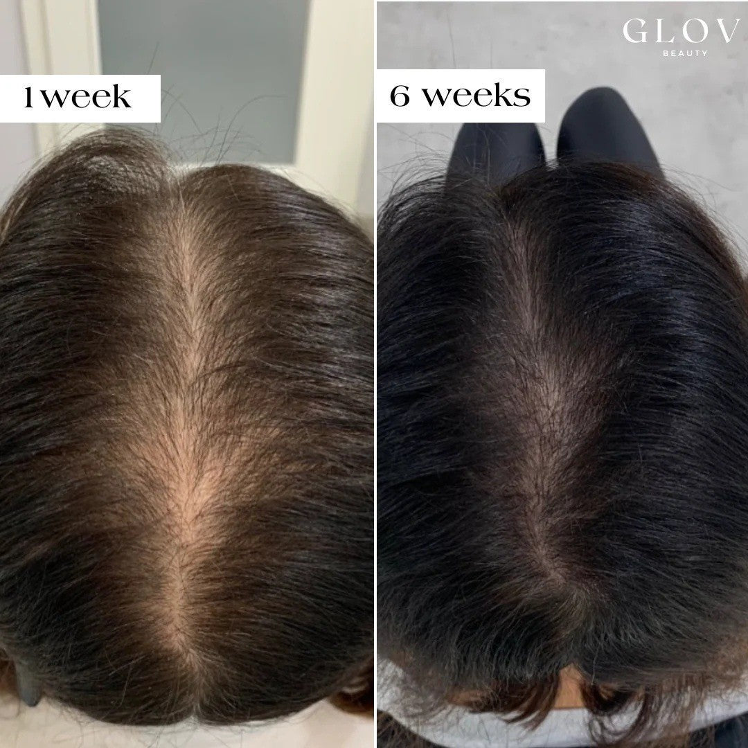 Anti-hair loss micro needling kit