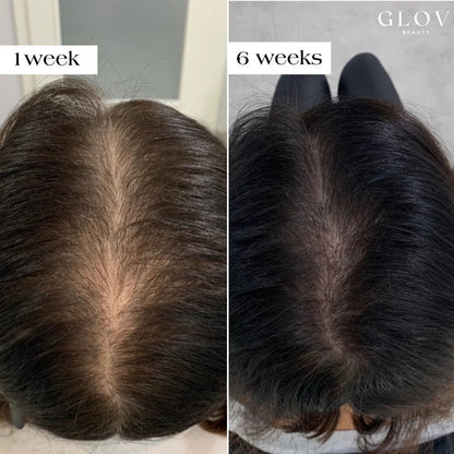 Anti-hair loss micro needling kit