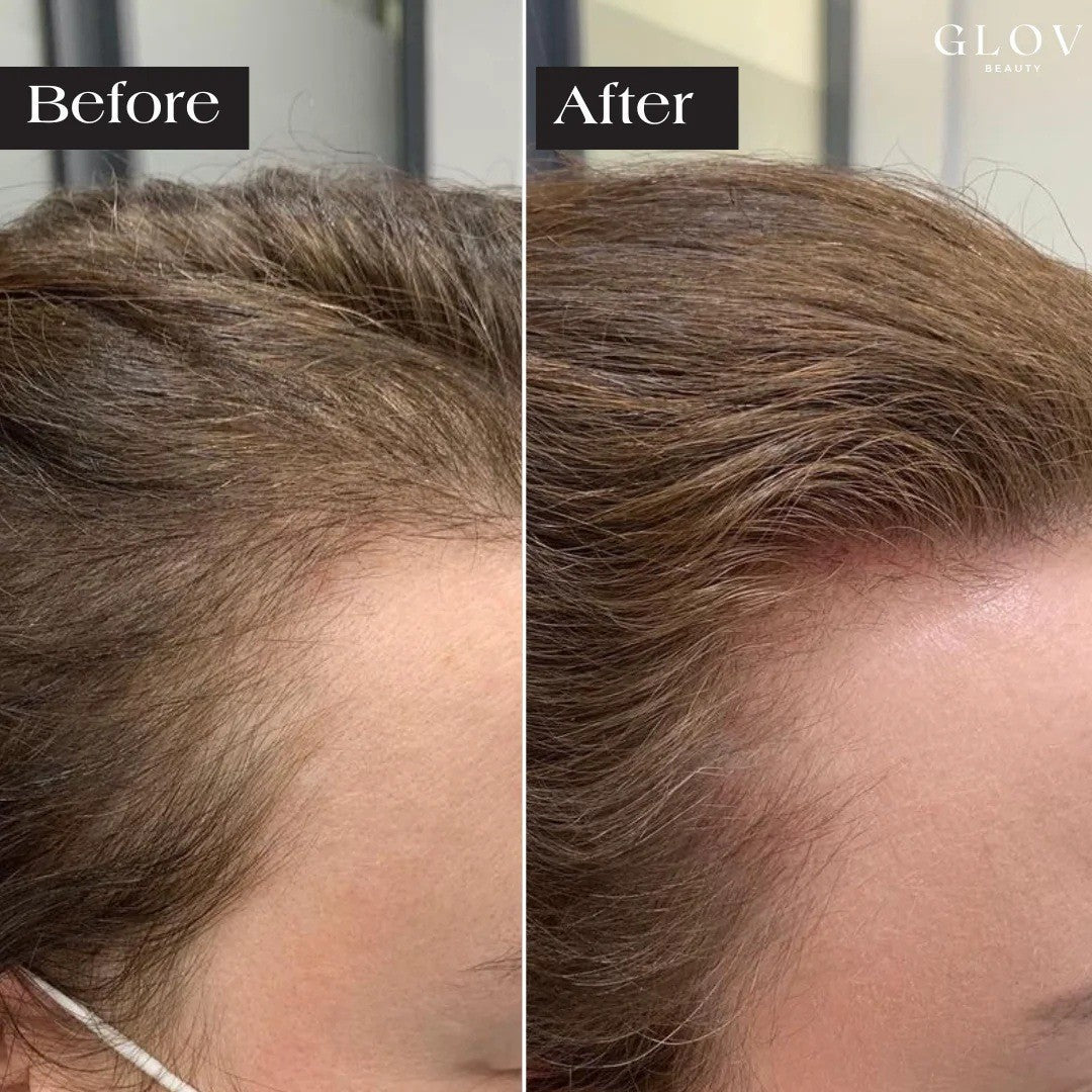 Anti-hair loss micro needling kit