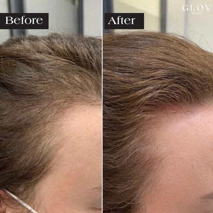Anti-hair loss micro needling kit